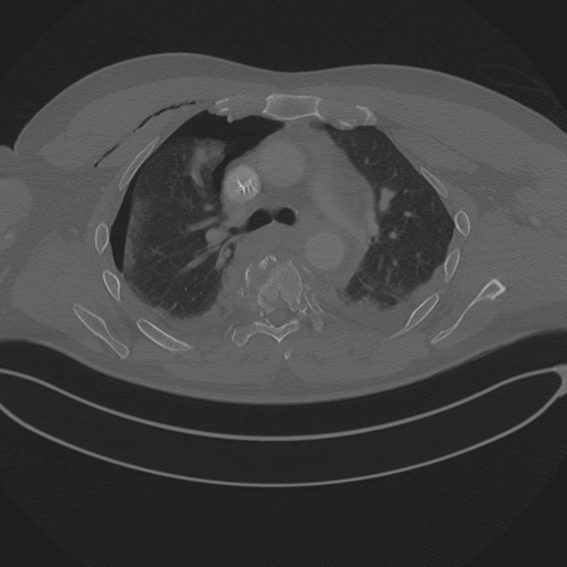 Chest multitrauma - aortic injury (Radiopaedia 34708-36147 Axial bone window 113).png