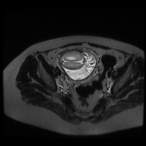 Chiari II malformation - fetal MRI (Radiopaedia 68099-77581 Axial T2-SSFSE 50).jpg