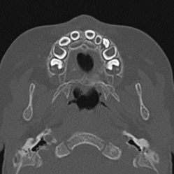 File:Choanal atresia (Radiopaedia 88525-105975 Axial bone window 6).jpg
