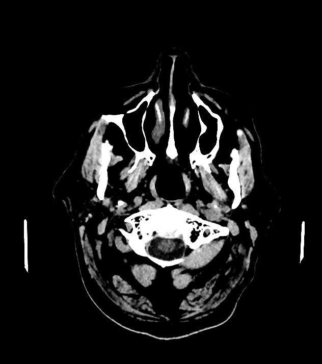 Cholangiocarcinoma with cerebral metastases (Radiopaedia 83519-98628 Axial non-contrast 6).jpg