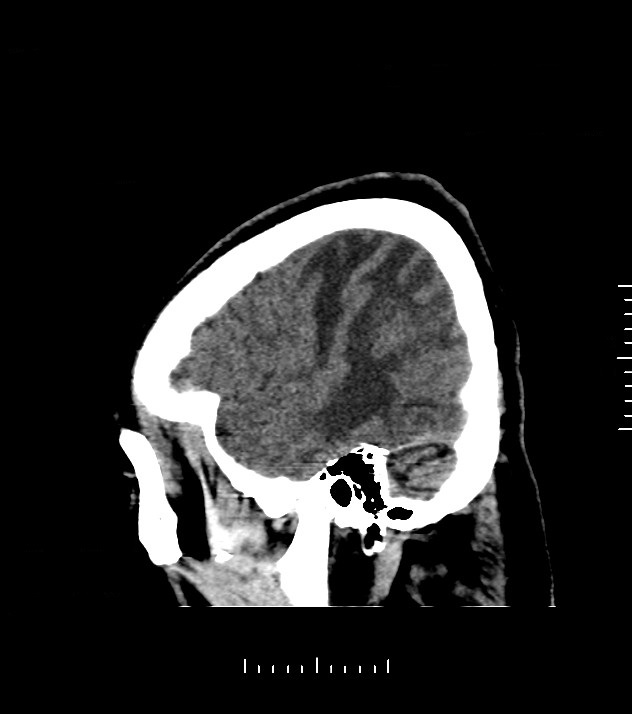 Cholangiocarcinoma with cerebral metastases (Radiopaedia 83519-98628 C 7).jpg