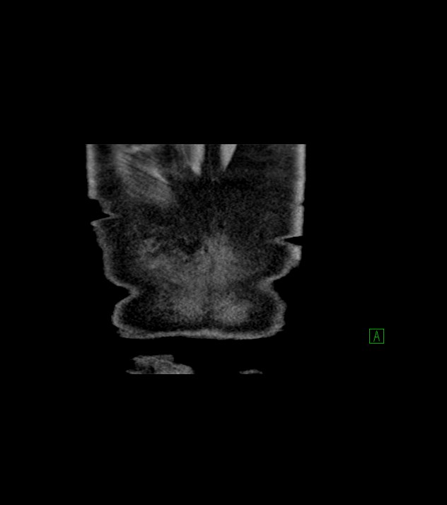 Cholangiocarcinoma with cerebral metastases (Radiopaedia 83519-98629 Coronal C+ delayed 83).jpg