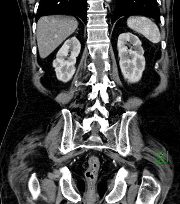 Cholangiocarcinoma with cerebral metastases (Radiopaedia 83519-98629 E 65).jpg