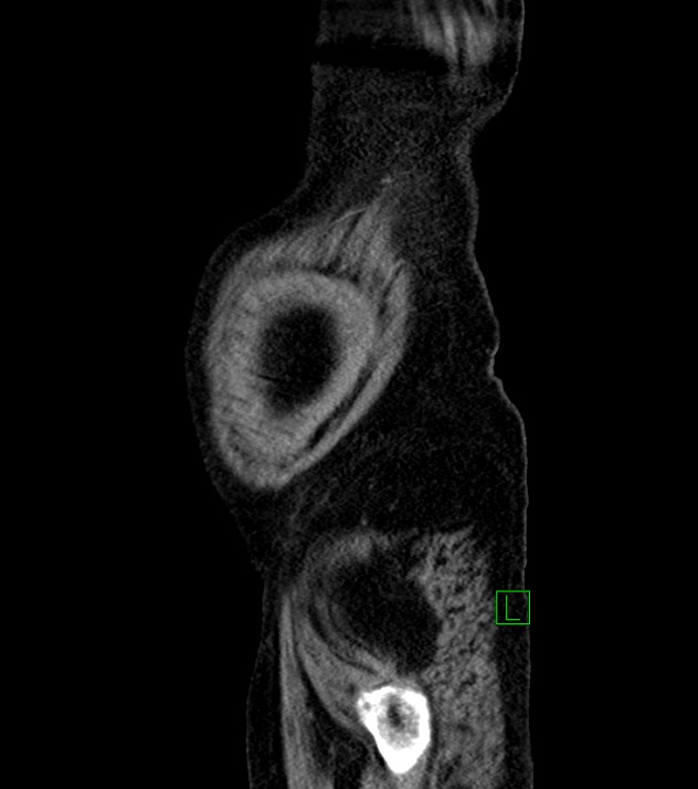 Cholangiocarcinoma with cerebral metastases (Radiopaedia 83519-98629 F 111).jpg