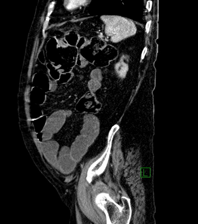 Cholangiocarcinoma with cerebral metastases (Radiopaedia 83519-98629 F 30).jpg