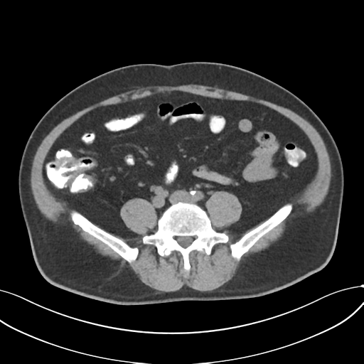 Cholecystitis with focal perforation and hepatic abscess (Radiopaedia 37189-38945 Axial non-contrast 56).png