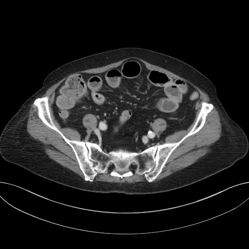 Cholecystoduodenal fistula due to calculous cholecystitis with gallstone migration (Radiopaedia 86875-103077 D 59).jpg