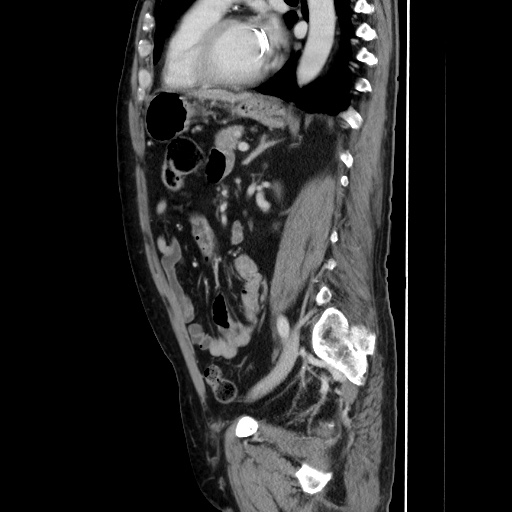 Choledocholiathiasis with normal caliber common bile duct (Radiopaedia 75368-86632 D 101).jpg