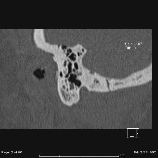 Cholesteatoma - external auditory canal (Radiopaedia 88452-105096 Sagittal bone window 3).jpg