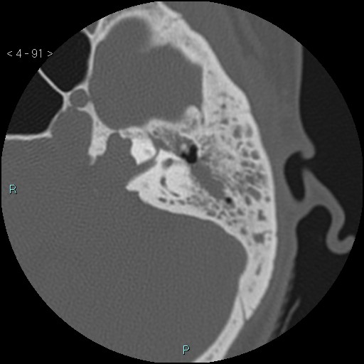File:Cholesterol granuloma of the petrous apex (Radiopaedia 64358-73141 Axial bone window 44).jpg