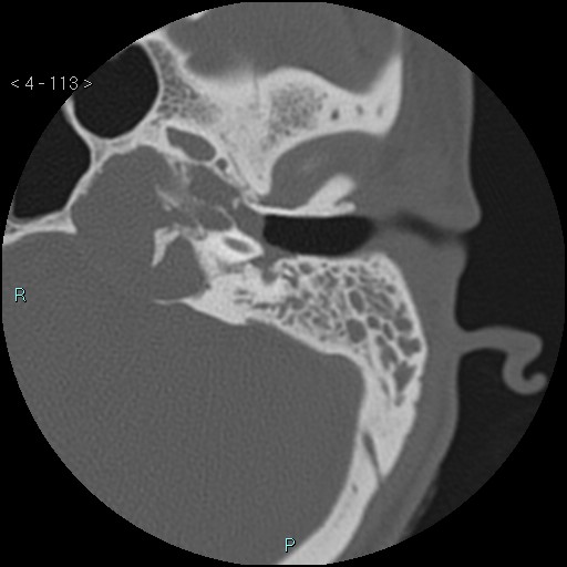 File:Cholesterol granuloma of the petrous apex (Radiopaedia 64358-73141 Axial bone window 55).jpg