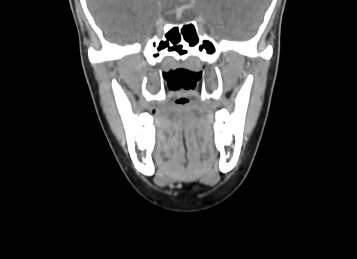 Chondroblastic osteosarcoma (Radiopaedia 67363-76741 D 52).jpg