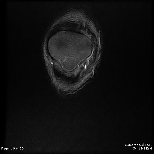File:Chondroblastoma (Radiopaedia 25725-25891 Coronal STIR 19).jpg