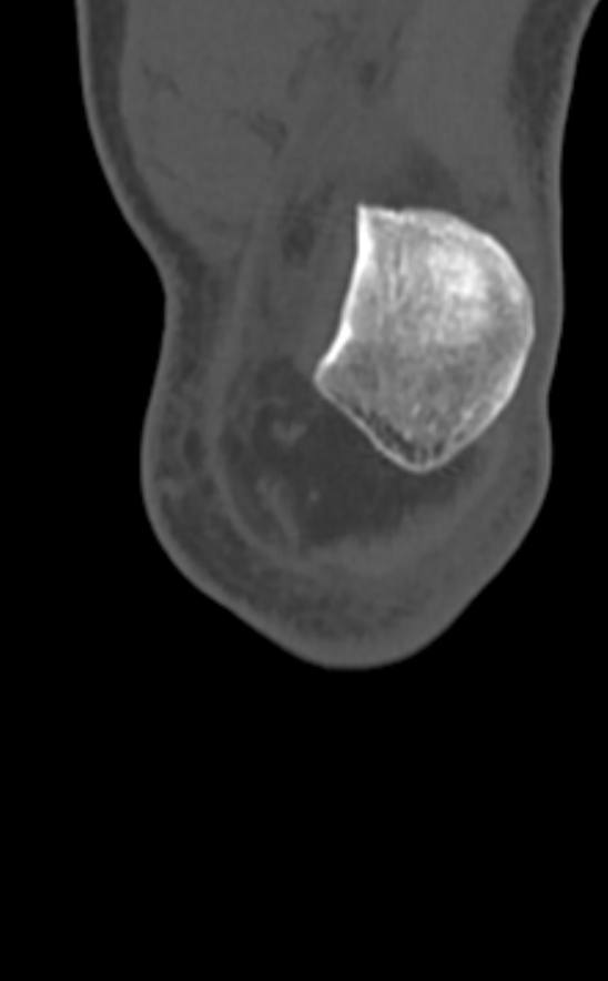 Chondrocalcinosis (Radiopaedia 82862-97173 Coronal bone window 13).jpg