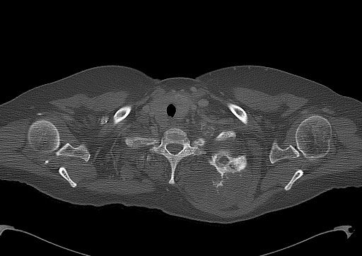 Chondrosarcoma - chest wall (Radiopaedia 65192-74199 Axial bone window 12).jpg