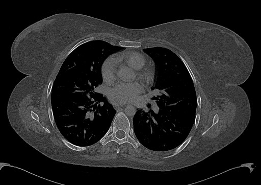 File:Chondrosarcoma - chest wall (Radiopaedia 65192-74199 Axial bone window 62).jpg