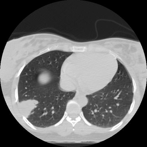 File:Choriocarcinoma of ovary with cerebral and pulmonary metastases (Radiopaedia 25983-26119 Axial lung window 13).jpg