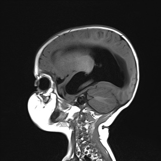 File:Choroid plexus papilloma (Radiopaedia 84612-100019 Sagittal T1 17).jpg