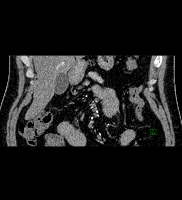 Chromophobe renal cell carcinoma (Radiopaedia 84286-99573 E 3).jpg