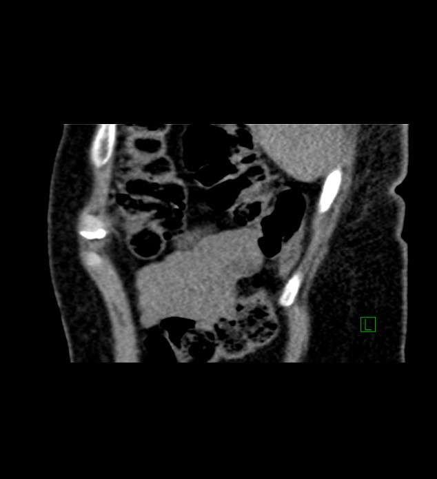 Chromophobe renal cell carcinoma (Radiopaedia 84290-99582 D 11).jpg