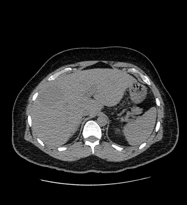 Chromophobe renal cell carcinoma (Radiopaedia 84337-99693 Axial non-contrast 23).jpg
