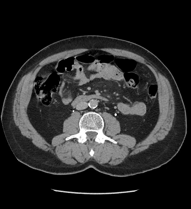 Chromophobe renal cell carcinoma (Radiopaedia 86879-103083 D 75).jpg