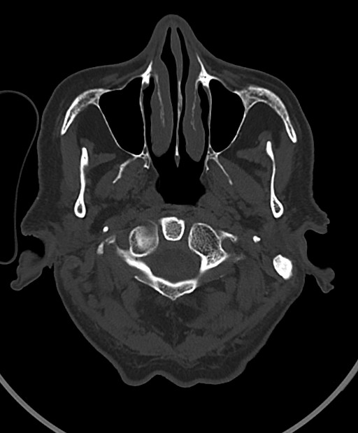 Chronic bilateral subdural hygroma (Radiopaedia 85801-101623 Axial bone window 113).jpg