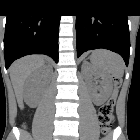File:Chronic calcific pancreatitis (Radiopaedia 56280-62953 Coronal non-contrast 24).jpg