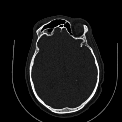 Chronic invasive fungal sinusitis (Radiopaedia 91563-109286 Axial sinus 125).jpg