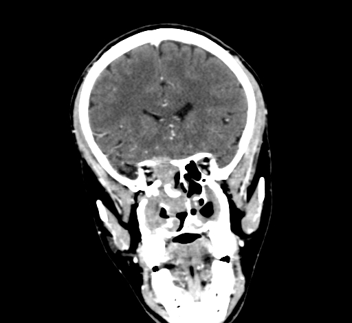 Chronic invasive fungal sinusitis with intraorbital and intracranial extension (Radiopaedia 56387-63046 C 137).jpg