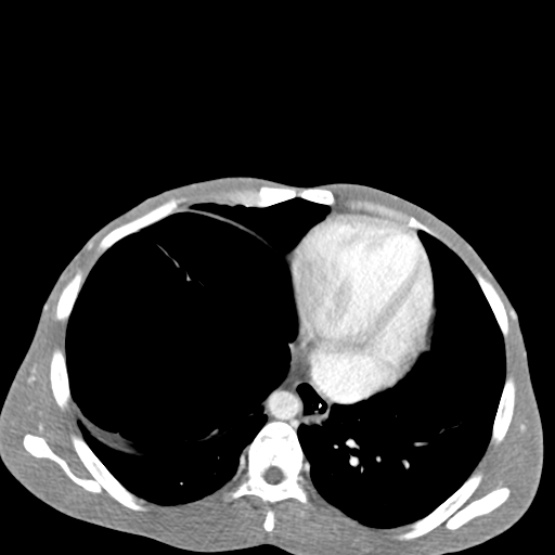 Chronic large bowel pseudo-obstruction (Radiopaedia 43181-46492 A 27).jpg