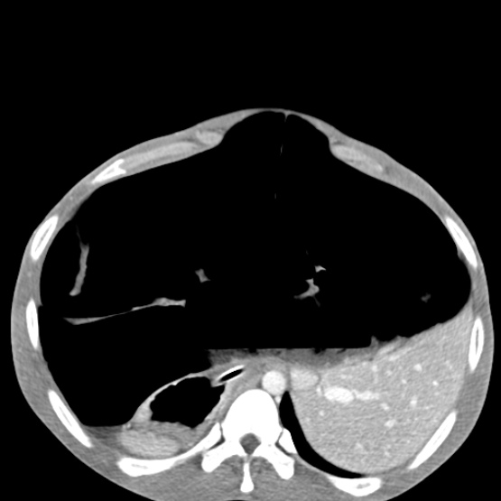 File:Chronic large bowel pseudo-obstruction (Radiopaedia 43181-46492 A 48).jpg