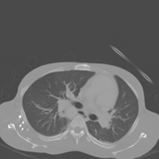 File:Chronic large bowel pseudo-obstruction (Radiopaedia 43181-46492 Axial bone window 8).jpg