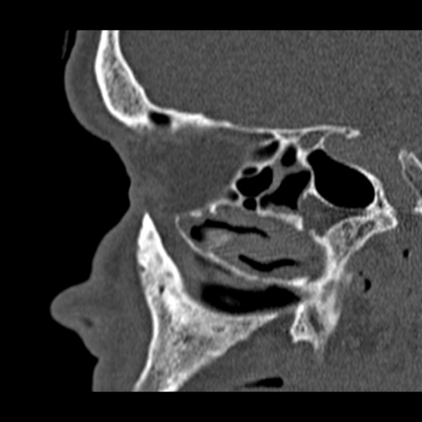 Chronic maxillary sinusitis (Radiopaedia 27879-28116 Sagittal bone window 37).jpg