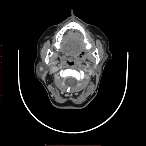 File:Chronic osteomyelitis - maxilla (Radiopaedia 23783-23927 B 55).jpg