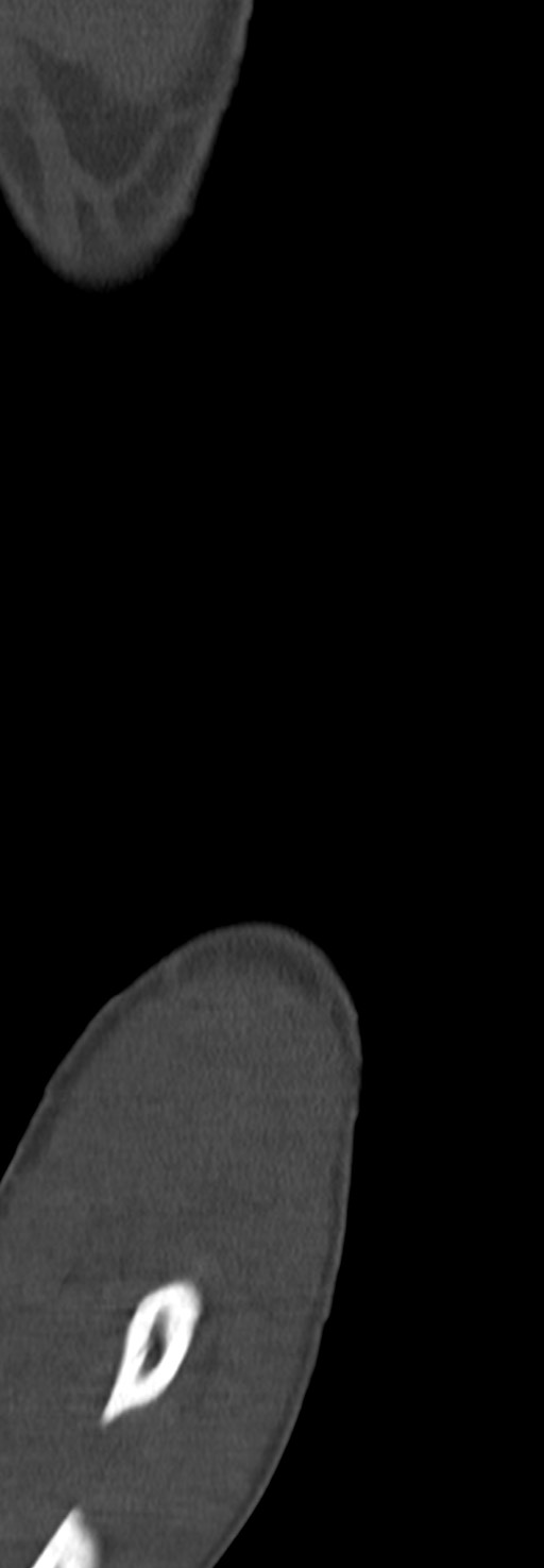 Chronic osteomyelitis of the distal humerus (Radiopaedia 78351-90971 Sagittal bone window 25).jpg