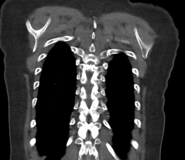 Chronic pulmonary embolus (Radiopaedia 39129-41341 Coronal C+ CTPA 72).png