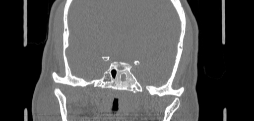 File:Chronic sphenoidal sinusitis (Radiopaedia 62030-70122 Coronal bone window 131).jpg