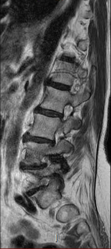File:Chronic spinal hematoma with cauda equina syndrome (Radiopaedia 75745-87090 Sagittal T2 3).png