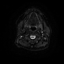 Chronic submandibular sialadenitis (Radiopaedia 61852-69885 Axial DWI 43).jpg