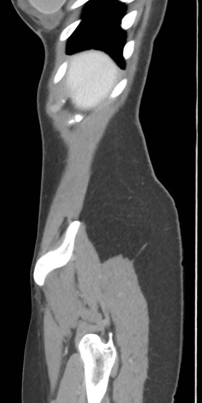 Circumaortic left renal vein with a duplicated retroaortic vein (Radiopaedia 91668-109398 C 6).jpg