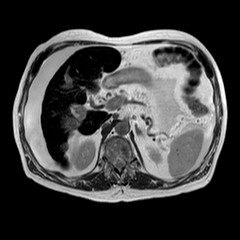 File:Cirrhosis and hepatocellular carcinoma in the setting of hemochromatosis (Radiopaedia 75394-86594 Axial T2 15).jpg