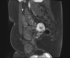 File:Class II Mullerian duct anomaly- unicornuate uterus with rudimentary horn and non-communicating cavity (Radiopaedia 39441-41755 G 76).jpg