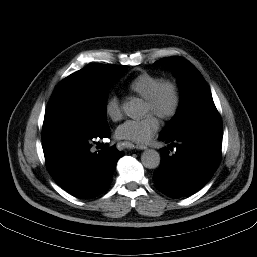File:Classic complicated silicosis (Radiopaedia 49720-54961 Axial liver window 33).jpg
