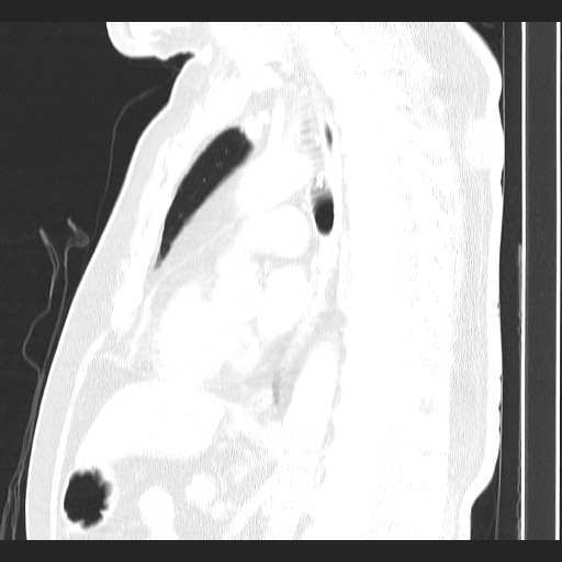 Classic complicated silicosis (Radiopaedia 49720-54961 Sagittal lung window 30).jpg