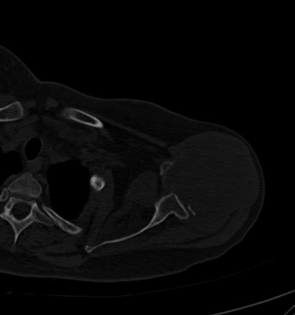 Clear cell chondrosarcoma - humerus (Radiopaedia 63104-71612 Axial bone window 31).jpg
