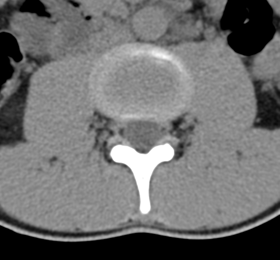 Clear cell meningoma - lumbar spine (Radiopaedia 60116-67691 Axial non-contrast 32).png