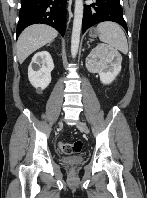 Clear cell renal cell carcinoma (Radiopaedia 61449-69393 F 30).jpg