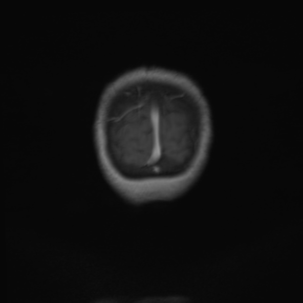 File:Clival meningioma (Radiopaedia 53278-59248 F 28).jpg