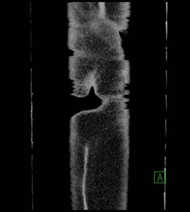 Closed-loop small bowel obstruction-internal hernia (Radiopaedia 78439-91096 Coronal non-contrast 107).jpg